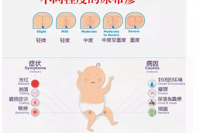 五个月宝宝屁股红，原因、预防与处理方法